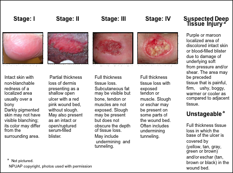 Diabetic Ulcers – Diabetic Ulcers